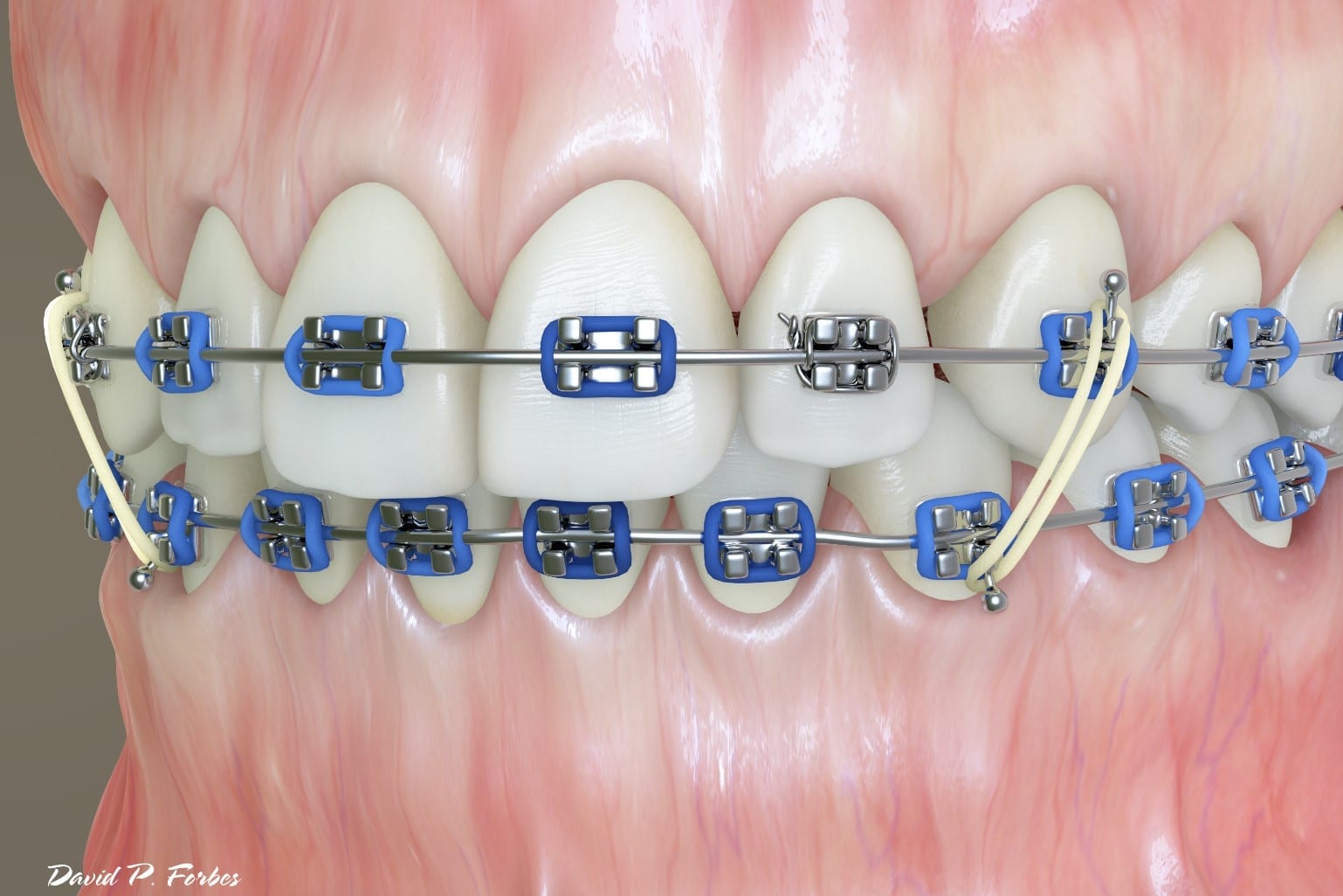 How elastics (rubber bands) SHOULD be used in orthodontics