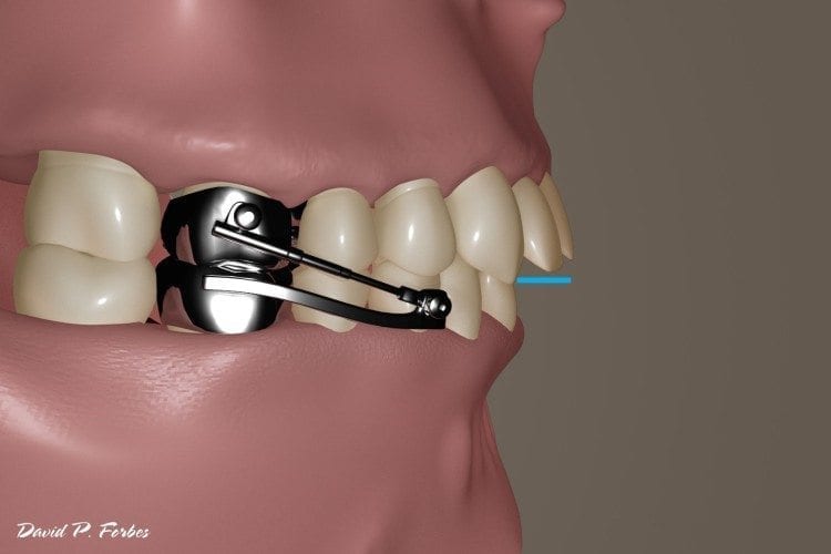 theherbstappliance Forbes Orthodontics