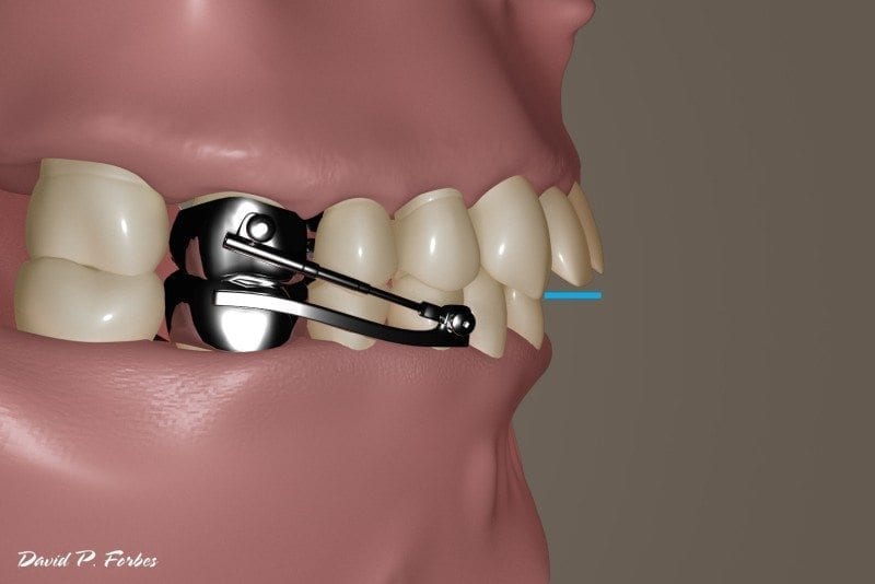 theherbstappliance Forbes Orthodontics