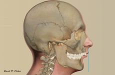 An illustration of patient with smaller lower jaw creating a discrepancy between the upper front teeth and lower front teeth. This patient’s problem requires jaw surgery to correct the discrepancy. The blue line indicates where the lower jaw should line up.