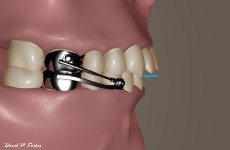 An illustration showing a Herbst appliance and the difference (blue line) between the upper and lower teeth (incisors). This appliance is designed to move the lower jaw forward.