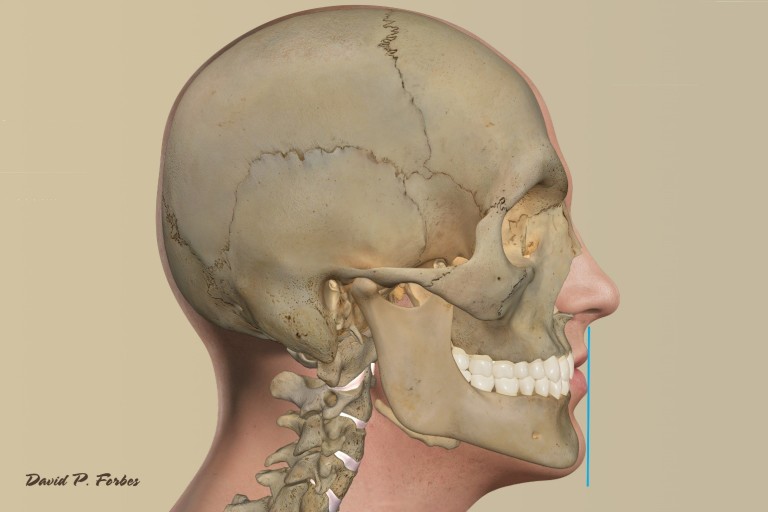 The Herbst Appliance Forbes Orthodontics