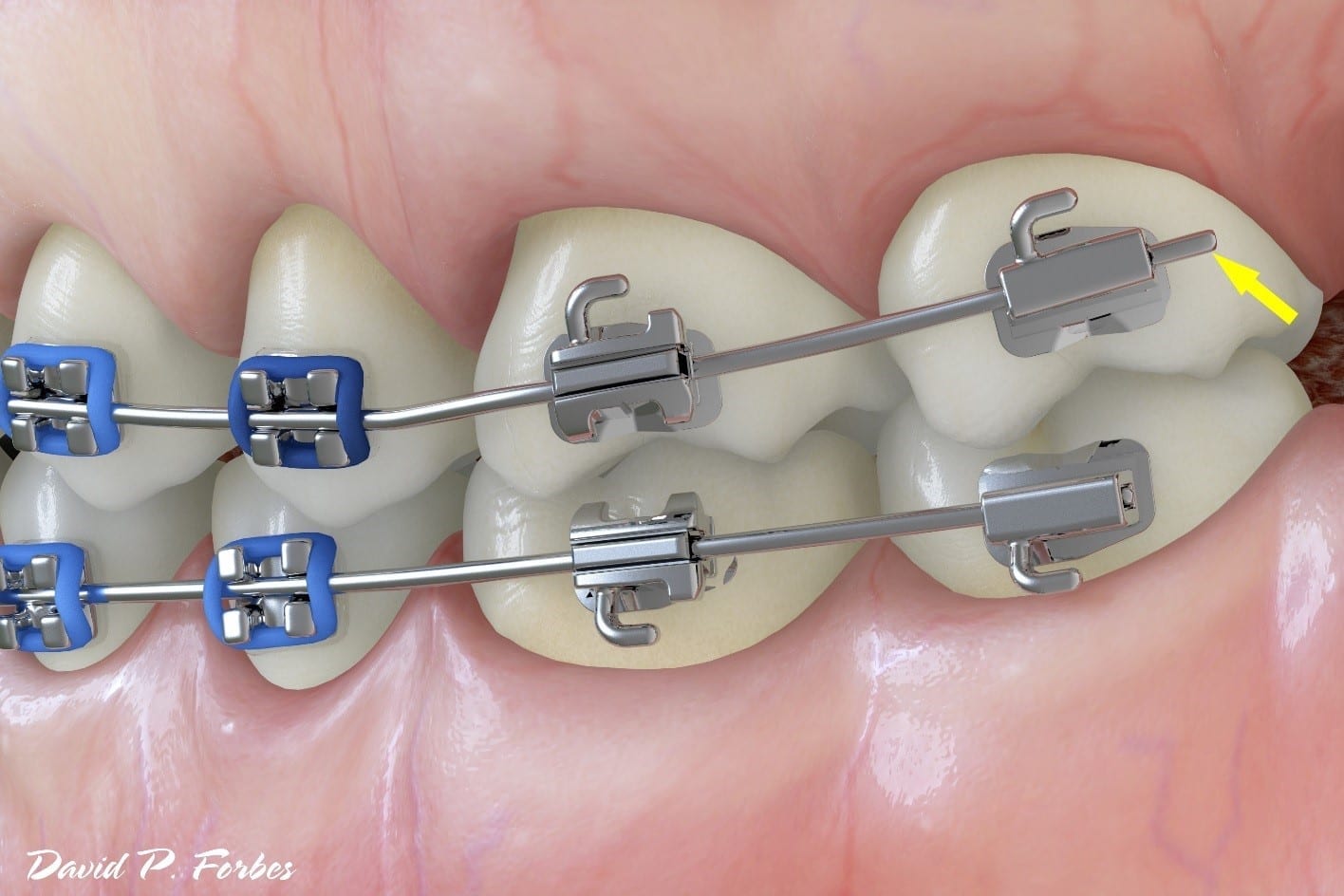 wire-poke - Forbes Orthodontics